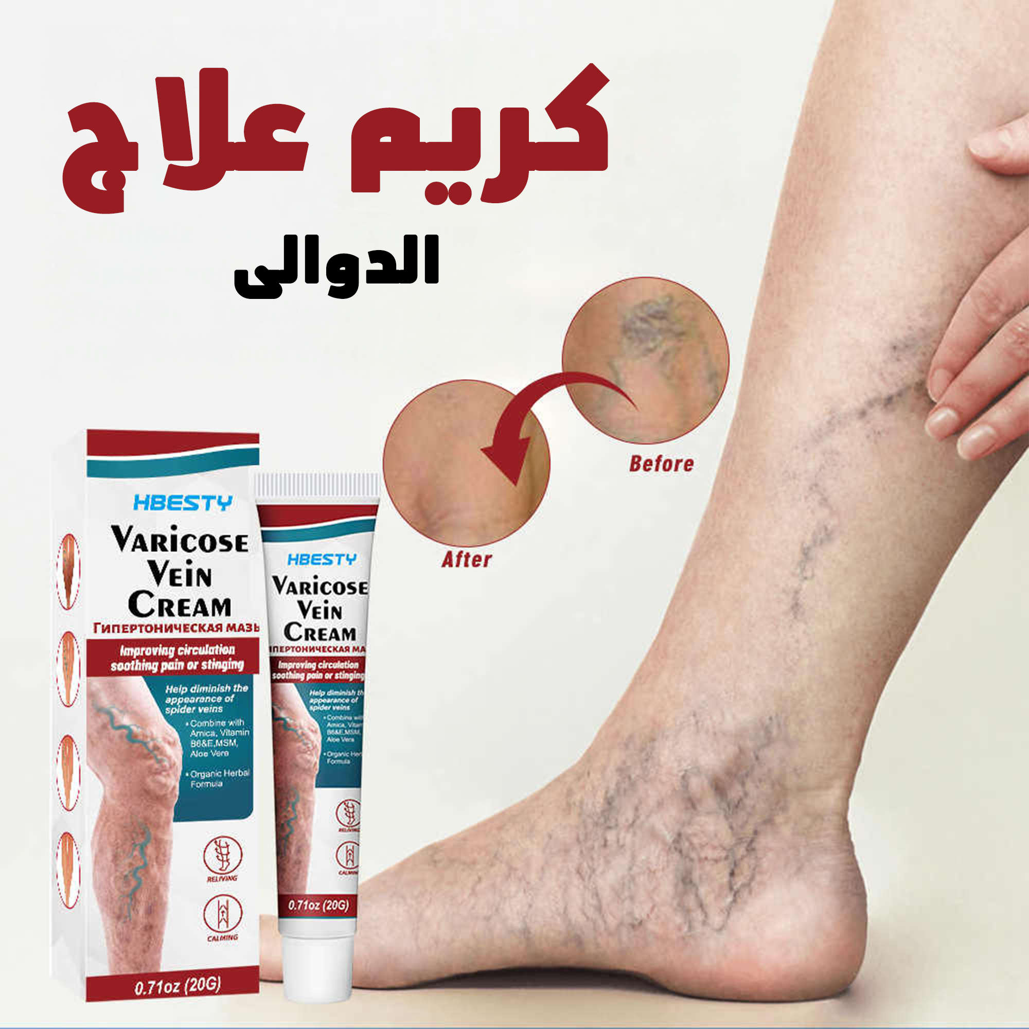 كريم علاج الدوالى